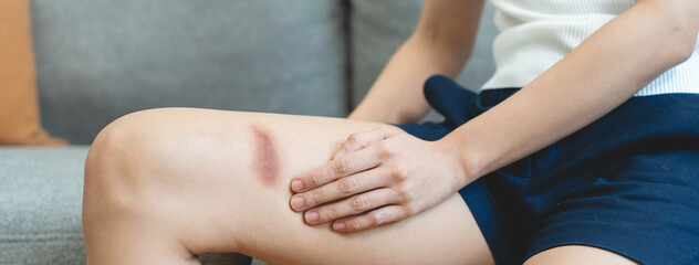 people get body injured concept, Close-up person got bruised on the leg.