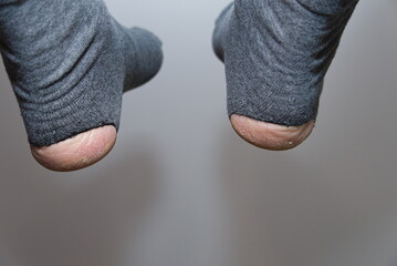 großes Loch in den Socken an der Ferse