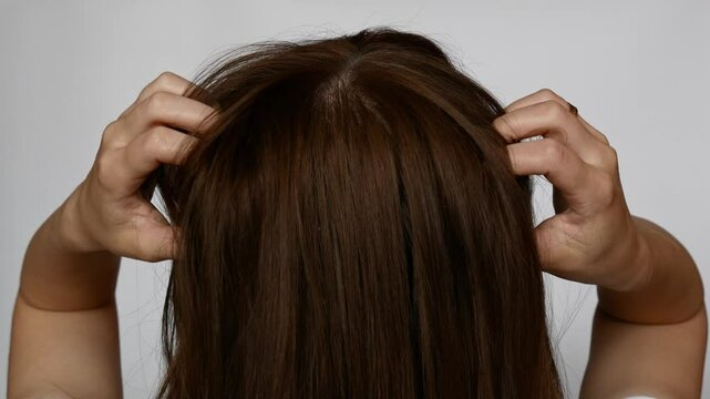  Close-up of woman suffering from itchy, flaky scalp and dandruff. Hair and scalp health problem.