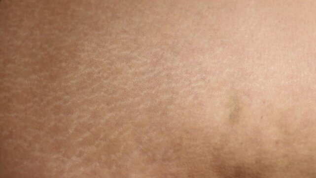 Human skin with stretch marks close -up