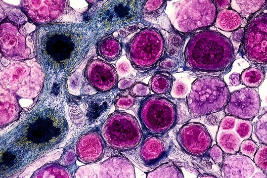 Real microscopic photo of pancreatic adenocarcinoma cells with irregular ducts and dense fibrotic tissue.