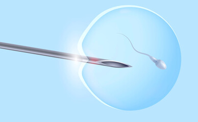 IVF, in vitro fertilization of an egg with a sperm. A medical needle implants the sperm into the egg. Medical poster.