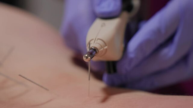Precision electrostim needle therapy tool targets back muscle during dry needling