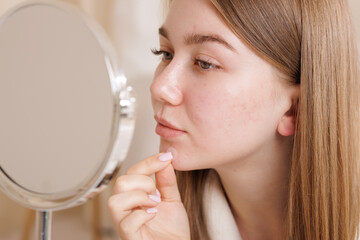 Girl uses transparent acne patch on chin and cheeks while checking skin in mirror.