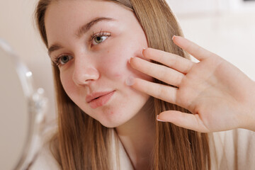 Young woman using acne patch on face, closeup skincare routine for blemish treatment.