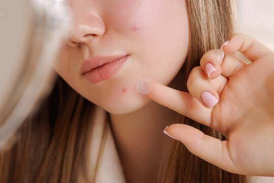 Girl placing hydrocolloid patch on acne spot for pimple treatment and skincare.