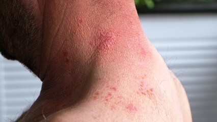 Skin lesion symptom in Shingles or Herpes zoster in person. Viral disease Varicella virus. Painful skin rash with blisters on the body. Red pimples. Insects bite. Body injury. High quality 4k footage