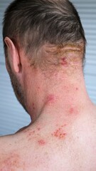 Naklejka premium Skin lesion symptom in Shingles or Herpes zoster in person. Viral disease Varicella virus. Painful skin rash with blisters on the body. Red pimples. Insects bite. Body injury. High quality