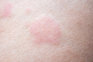 Skin allergy rash dermatitis texture close up