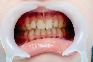 Open mouth showing teeth during dental checkup