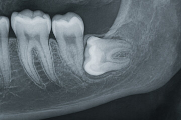 Impacted wisdom teeth for x-ray vision