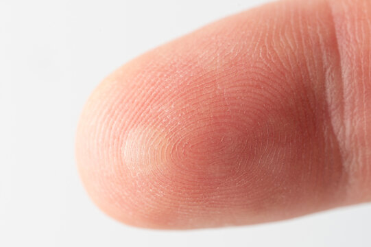Hurted finger skin with blister