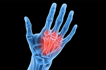 3d medical rendering of hand skeleton showing pain and inflammation. X-ray illustration of hand bones with inflammation highlighted in red.
