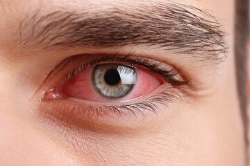 Obraz premium Close-up of a red, irritated human eye, showing visible blood vessels and inflammation.