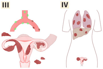Ovarian cancer Stage 3 and stage 4 diagram, Human anatomy