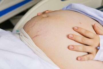 Unrecognizable pregnant woman in public hospital, seen at 45&deg; angle, caressing belly with visible stretch marks. Hours before birth. Maternal love and realism. Real people