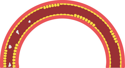 Celiac disease with gluten protien in small intestine.