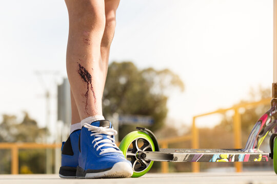 Injured leg with blood and scooter