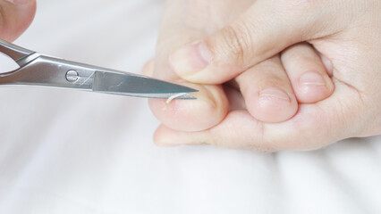 Close up view of a podiatrist skillfully cutting an ingrown toenail with surgical scissors,...