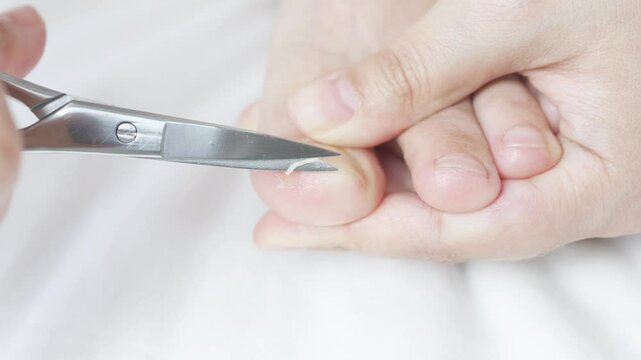 Podiatrist carefully trimming ingrown toenail with precise surgical scissors, addressing discomfort and preventing potential complications for optimal foot wellness