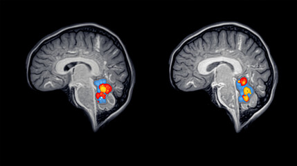 Axial MRI section of a human brain post-processed with colors showing the gray matter, white matter, ventricles and calvaria.