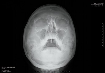 Frontal radiograph of a human skull, highlighting the cranial bones, facial bones, and sinuses