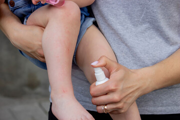 Scratches on a child's leg. small child.