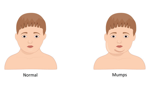 Mumps vector illustration