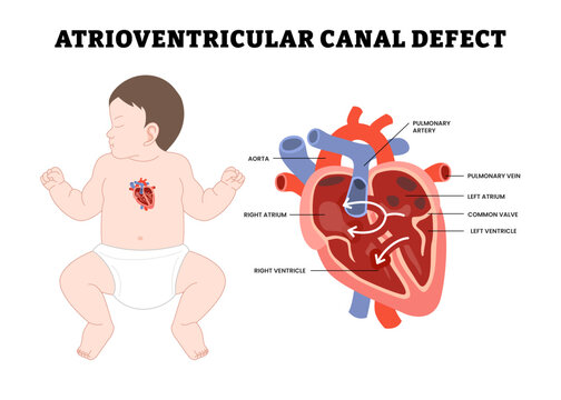 Baby Atrioventricular Canal Defect, educational medical poster design healthcare, labeled separating hole wall heart chamber, congenital heart, septum endocarditis congestive pulmonary hypertension.