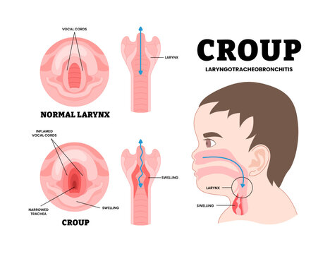 Baby croup laryngotracheobronchitis, educational medical poster design healthcare, labeled croup upper airway obstruct virus voice box vocal cord tube swollen noise baby child cold flu sick.