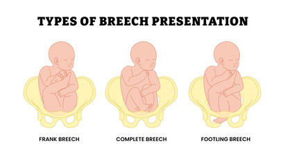 Different types of breech presentation types, educational medical poster design healthcare, labeled frank, complete, footling breech. Fetus in longitudinal lie buttocks or lower extremity pelvis.