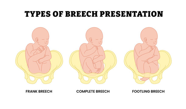 Different types of breech presentation types, educational medical poster design healthcare, labeled frank, complete, footling breech. Fetus in longitudinal lie buttocks or lower extremity pelvis.