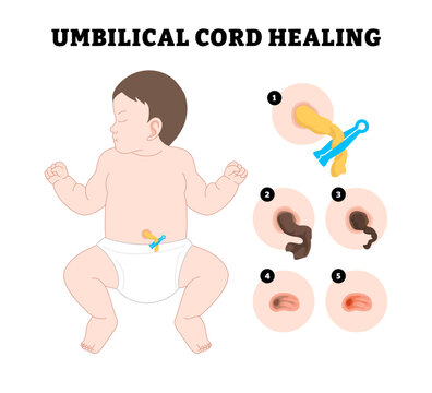 Baby Umbilical Cord Care Healing procedure steps, educational medical poster design healthcare, labeled after birth weeks cleaning umbilicus dry pus swollen fall off scar tissue.