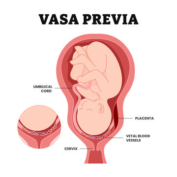 Baby vasa previa fetal infant baby born, educational medical poster design healthcare, labeled pregnancy complication, unprotected blood vessels or placenta from the umbilical cord of your cervix. 