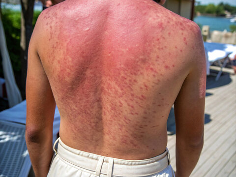 A severe skin reaction is evident on a person's torso and arms, characterized by a widespread red and bumpy rash with irregular, blotchy distribution, photographed outdoors