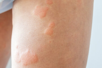 Fototapeta premium Young asian man has allergic skin rash on his legs from itchy dry skin eczema dermatitis insect bites