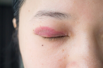 Close up of swelling and red eyelid allergic reaction