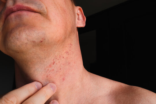 Skin irritation after shaving. Skin irritation on male neck after shaving. Close-up photo.