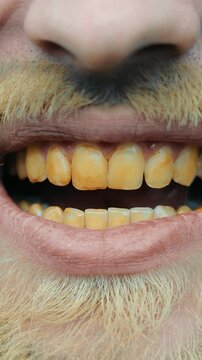 Male mouth with yellow dirty teeth. The mouth of a homeless man with a yellow beard and teeth