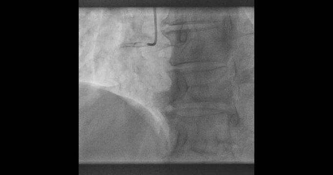 High-Resolution Coronary Angiogram &ndash; Detailed Medical Imaging of Heart Arteries