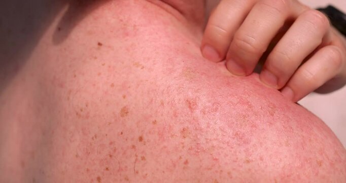 Woman hand gently touches sunburned skin on shoulder in room. Lady suffers form redness irritation and potential damage from excessive sun exposure