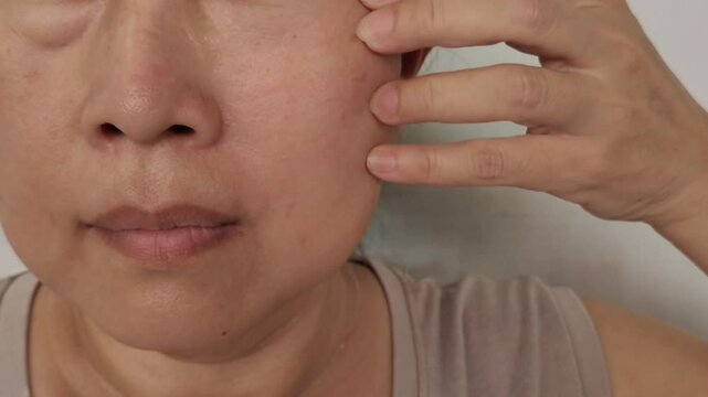 Portrait the fingers holding the flabbiness adipose sagging skin, swelling and ptosis beside the eyelids, dark spots and blemish, freckles and scar, Flabby skin on the face, health care and beauty.
