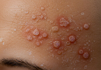 Fototapeta premium Closeup Image of Shingles Rash on Forehead Skin Texture Medical Dermatology