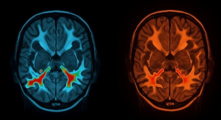Brain Scans Mri Images with Heat Map