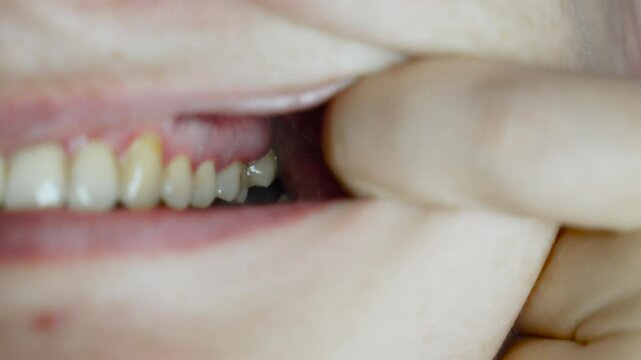 Inflammatory process in gums and above tooth in person, close-up. Dental abscess in gum pocket. Swelling of gums and formation of pus above teeth due to periodontitis.