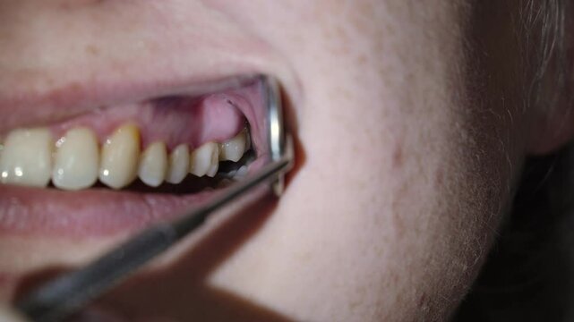 Dentist examines inflammatory process in patients oral cavity using dental mirror. Accumulation of pus and formation of edema above tooth. Transition of pulpitis to periodontitis.