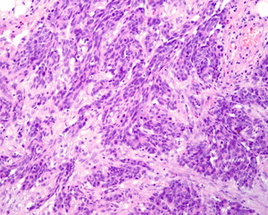 Obraz premium Undifferentiated adenocarcinoma. Metastatic nodule