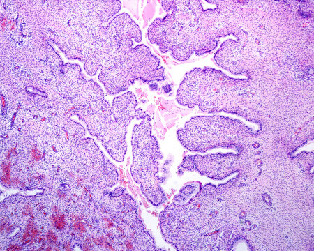 Human endocervical polyp