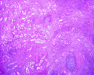 Kidney. Tuberculosis