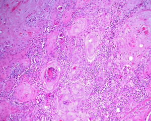 Larynx malign epithelioma.